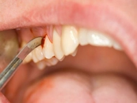 Cerrahi Diş Çekimi